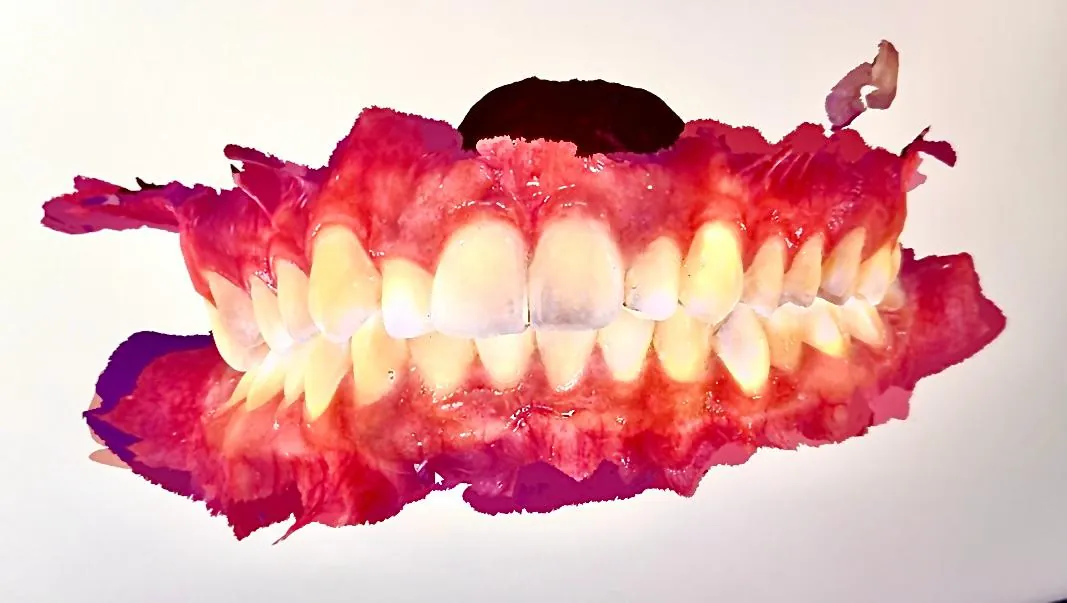An intraoral scanner capturing a digital model of the teeth